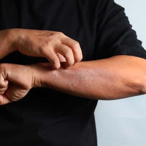 A man scratching dry patches on his arm caused from eczema