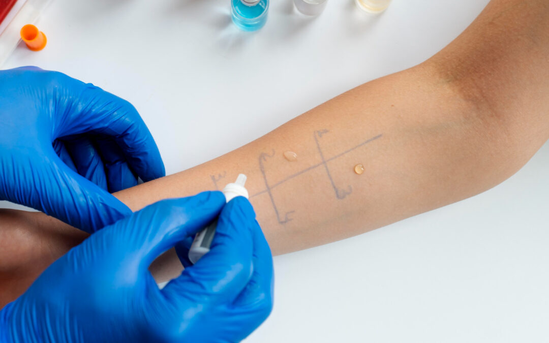 FAQs About Allergy Testing and How it Helps Manage Symptoms