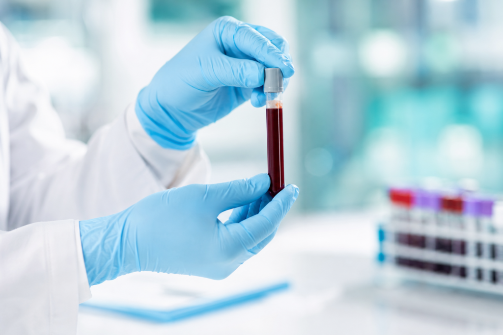 Allergy Blood Test Accuracy: What Results Really Mean 2 Clinician holding a blood sample vial for allergy blood test accuracy review